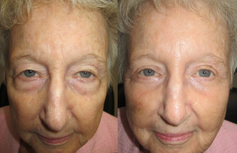 Eyelid Surgery Atlanta | Before And After Gallery | OPAL Aesthetics